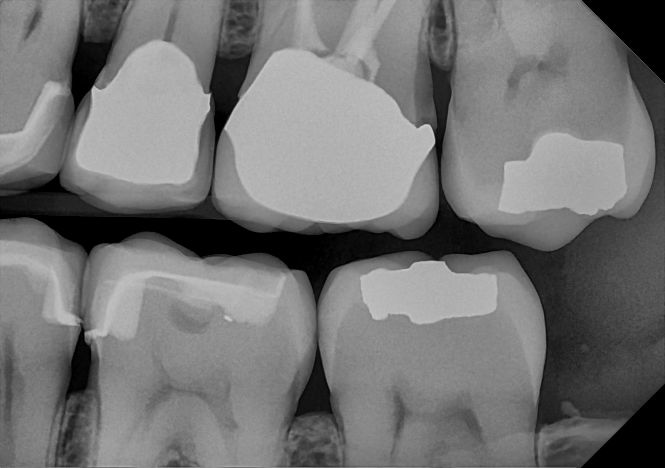 DC-Air Direct CMOS bitewing radiograph showing diagnostic detail