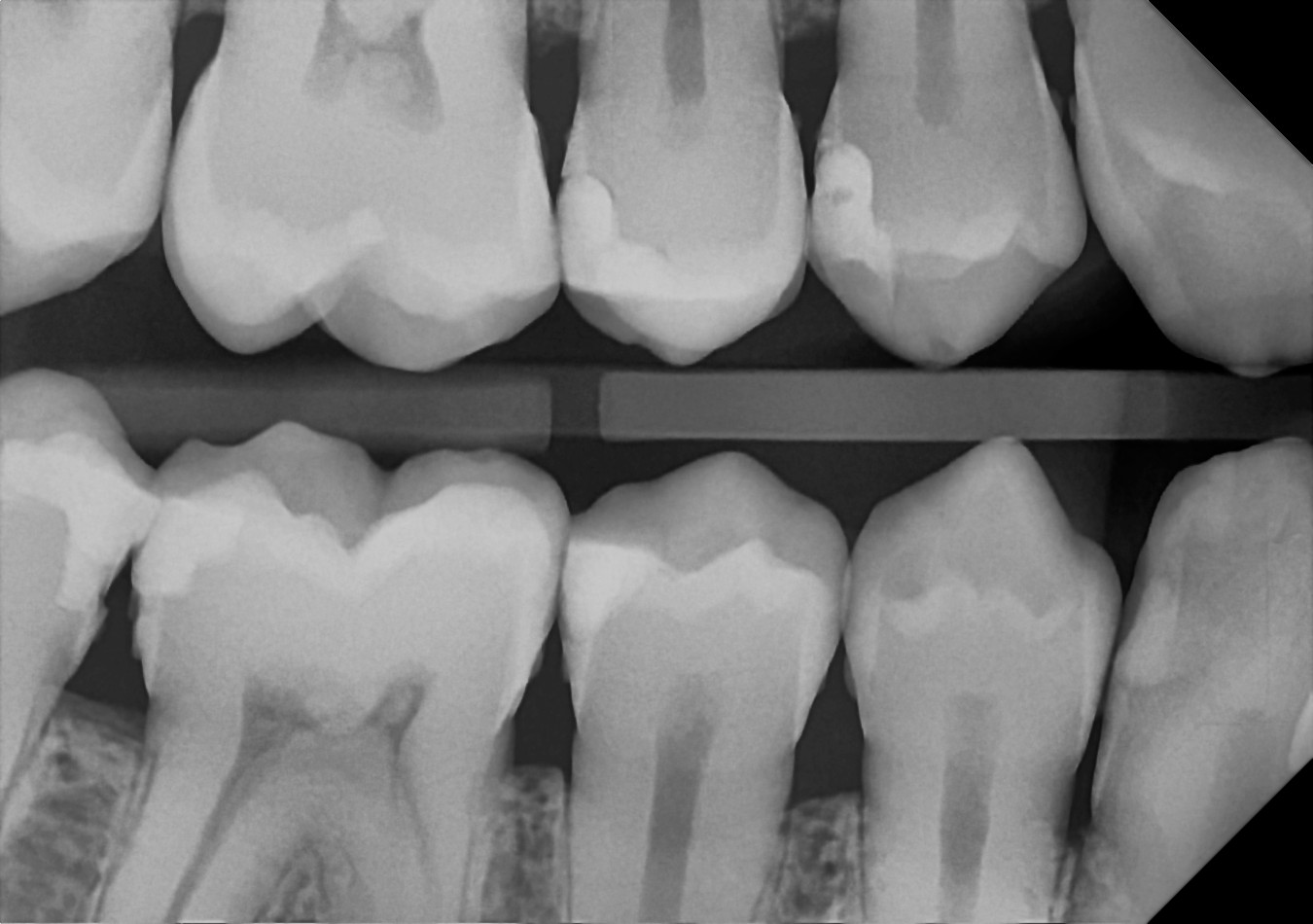 An example bitewing radiograph acquired with the DC-Air® wireless dental x-ray sensor.