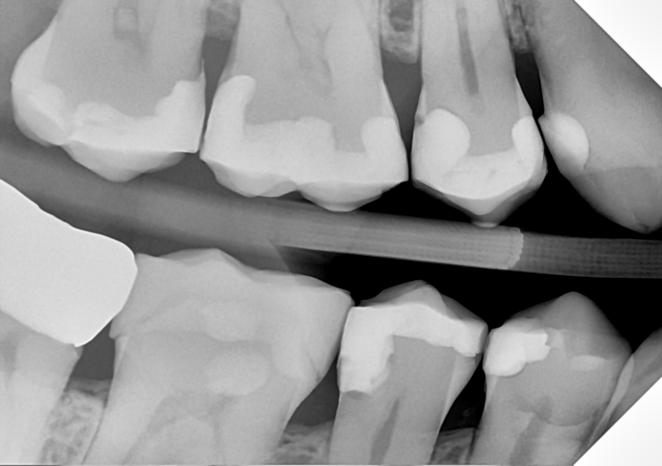 An example bitewing radiograph acquired with the DC-Air® wireless dental x-ray sensor.
