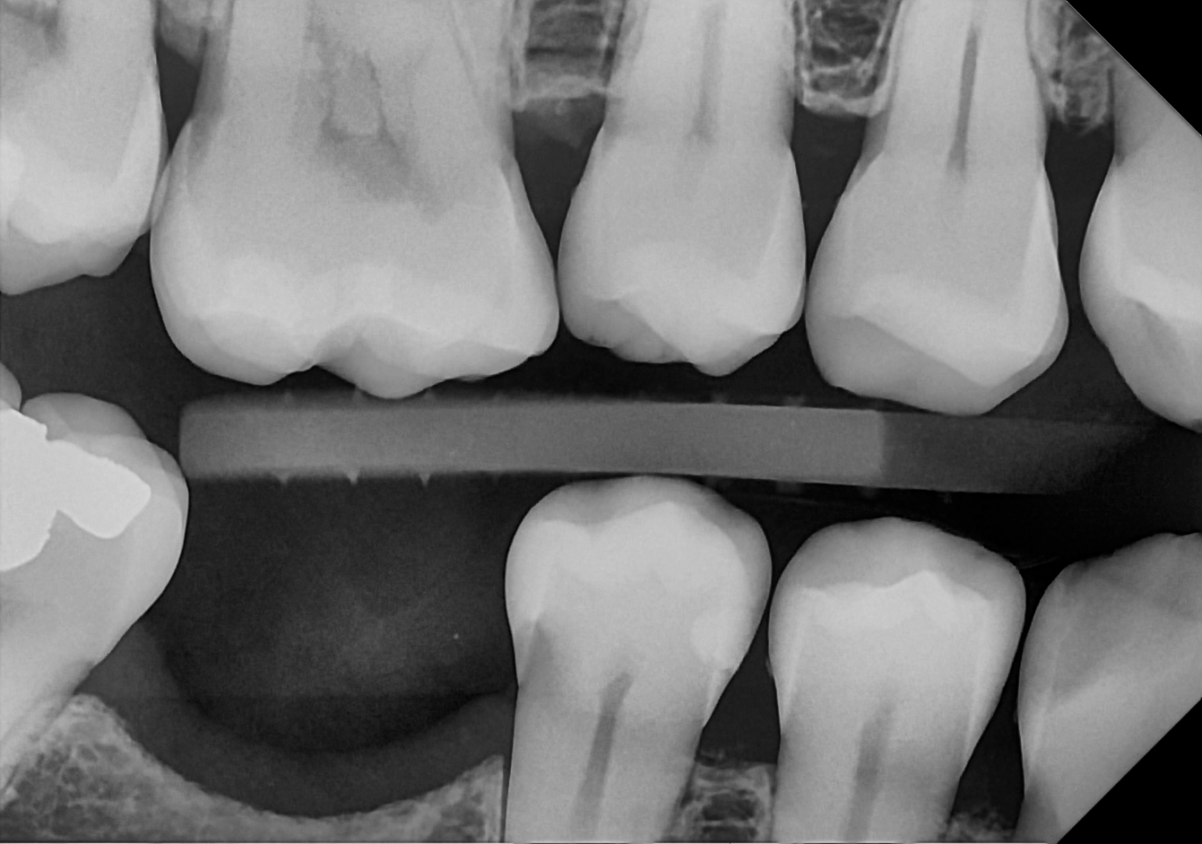 An example bitewing radiograph acquired with the DC-Air® wireless dental x-ray sensor.