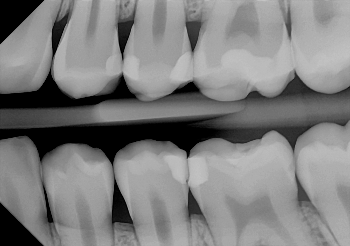 An example bitewing radiograph acquired with the DC-Air® wireless dental x-ray sensor.
