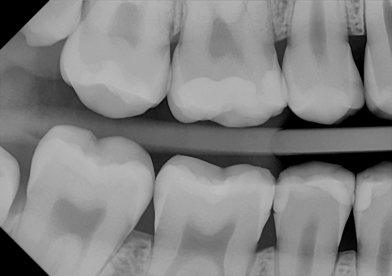 An example bitewing radiograph acquired with the DC-Air® wireless dental x-ray sensor.