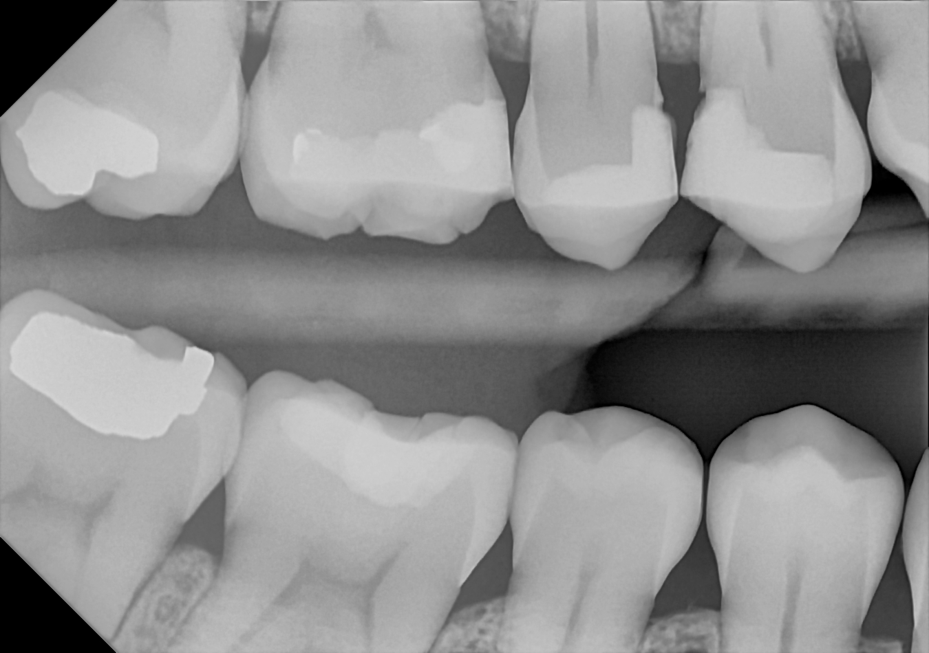 An example bitewing radiograph acquired with the DC-Air® wireless dental x-ray sensor.