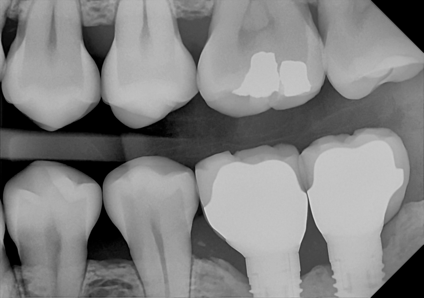 An example bitewing radiograph acquired with the DC-Air® wireless dental x-ray sensor.
