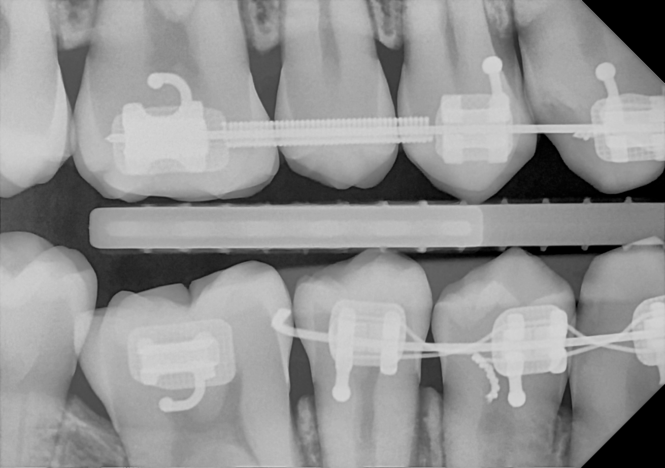 An example bitewing radiograph acquired with the DC-Air® wireless dental x-ray sensor.
