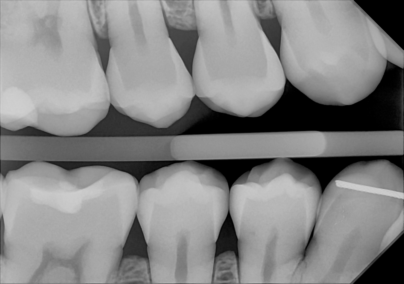 An example bitewing radiograph acquired with the DC-Air® wireless dental x-ray sensor.