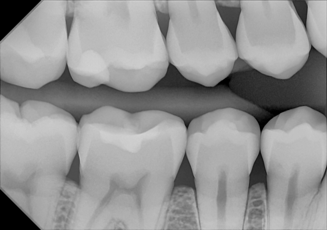 An example bitewing radiograph acquired with the DC-Air® wireless dental x-ray sensor.