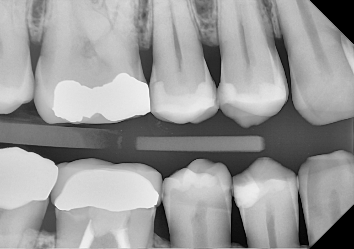 An example bitewing radiograph acquired with the DC-Air® wireless dental x-ray sensor.