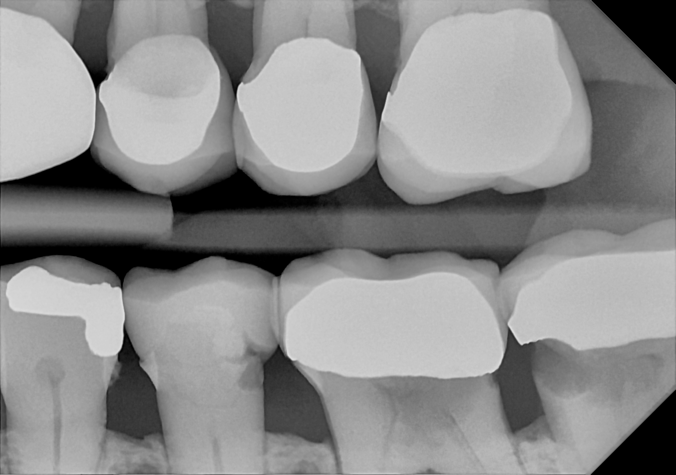 An example bitewing radiograph acquired with the DC-Air® wireless dental x-ray sensor.