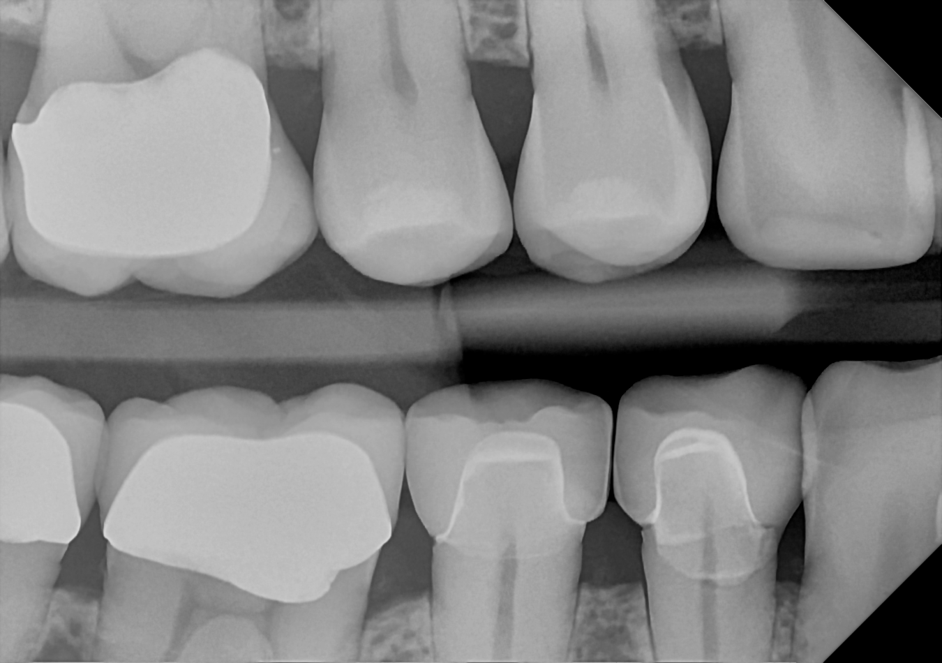An example bitewing radiograph acquired with the DC-Air® wireless dental x-ray sensor.