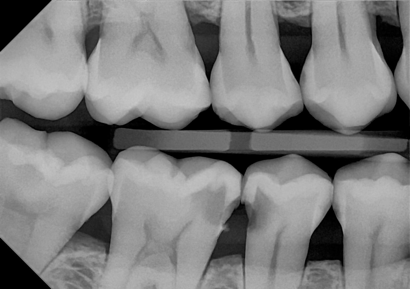 An example bitewing radiograph acquired with the DC-Air® wireless dental x-ray sensor.
