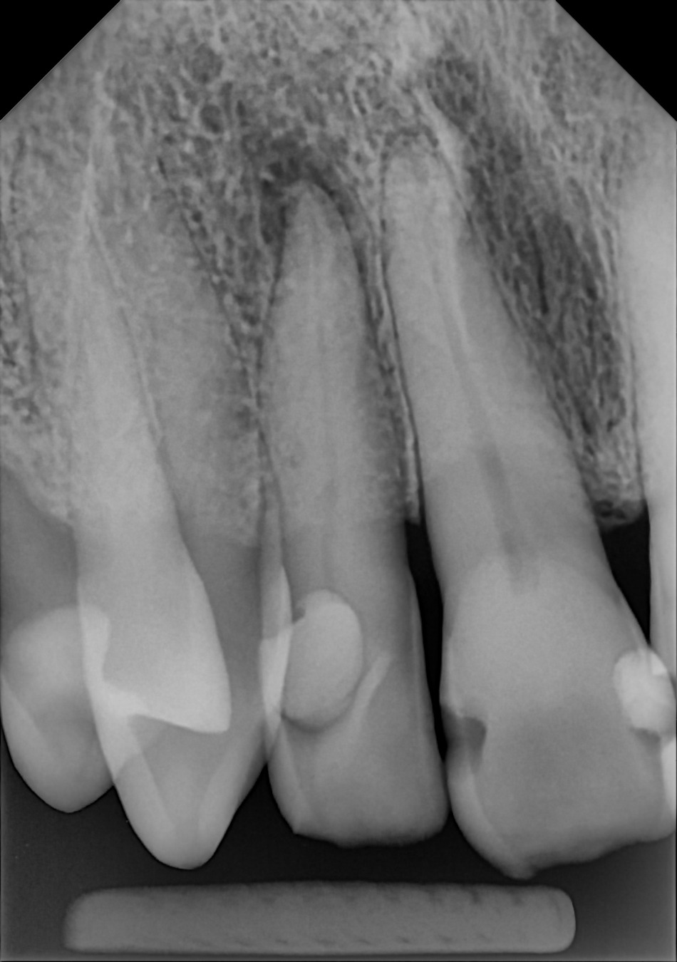 An example anterior periapical radiograph acquired with the DC-Air® wireless dental x-ray sensor.