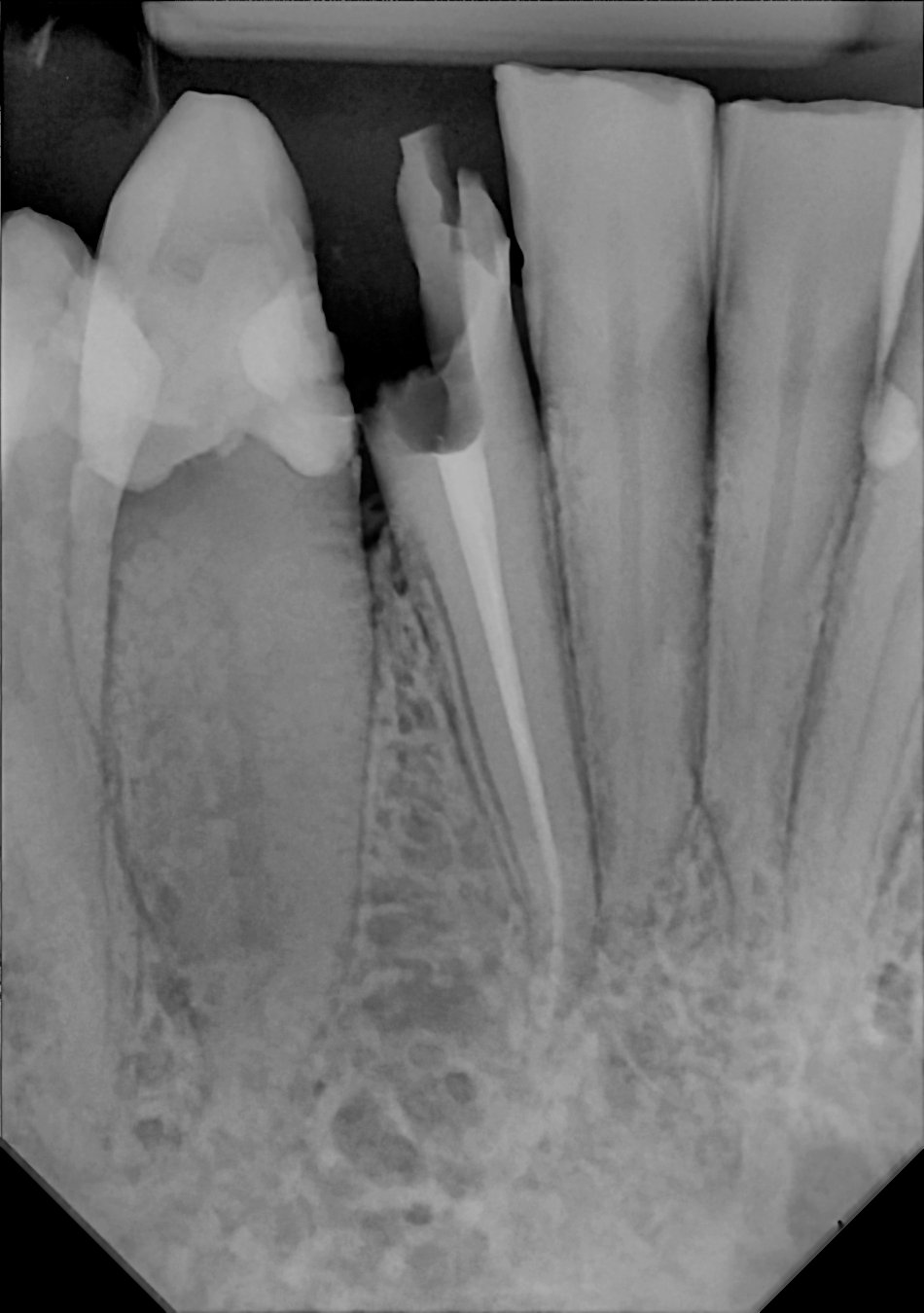 An example anterior periapical radiograph acquired with the DC-Air® wireless dental x-ray sensor.