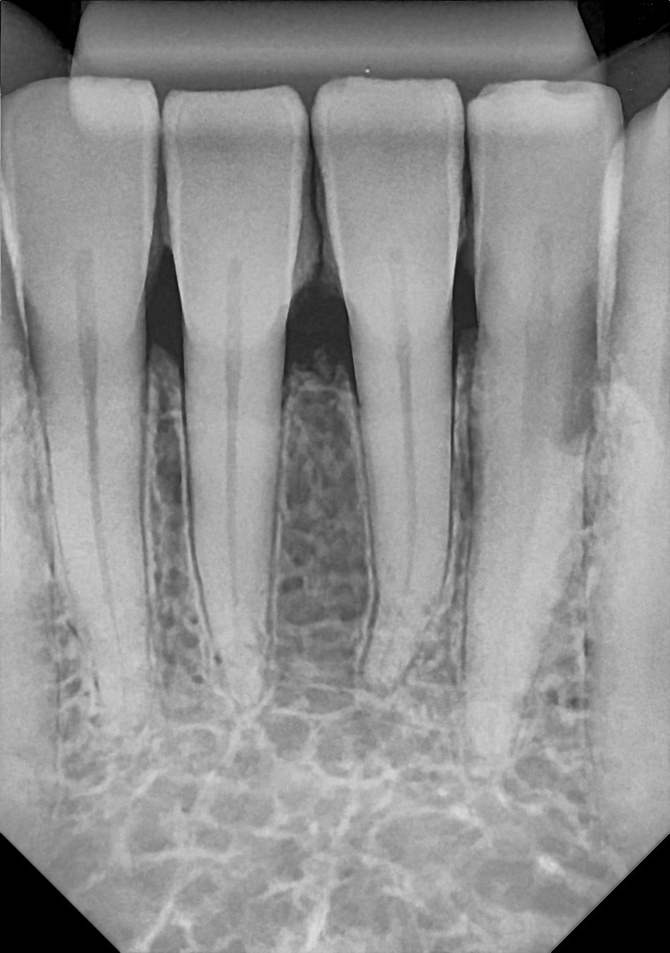 An example anterior periapical radiograph acquired with the DC-Air® wireless dental x-ray sensor.