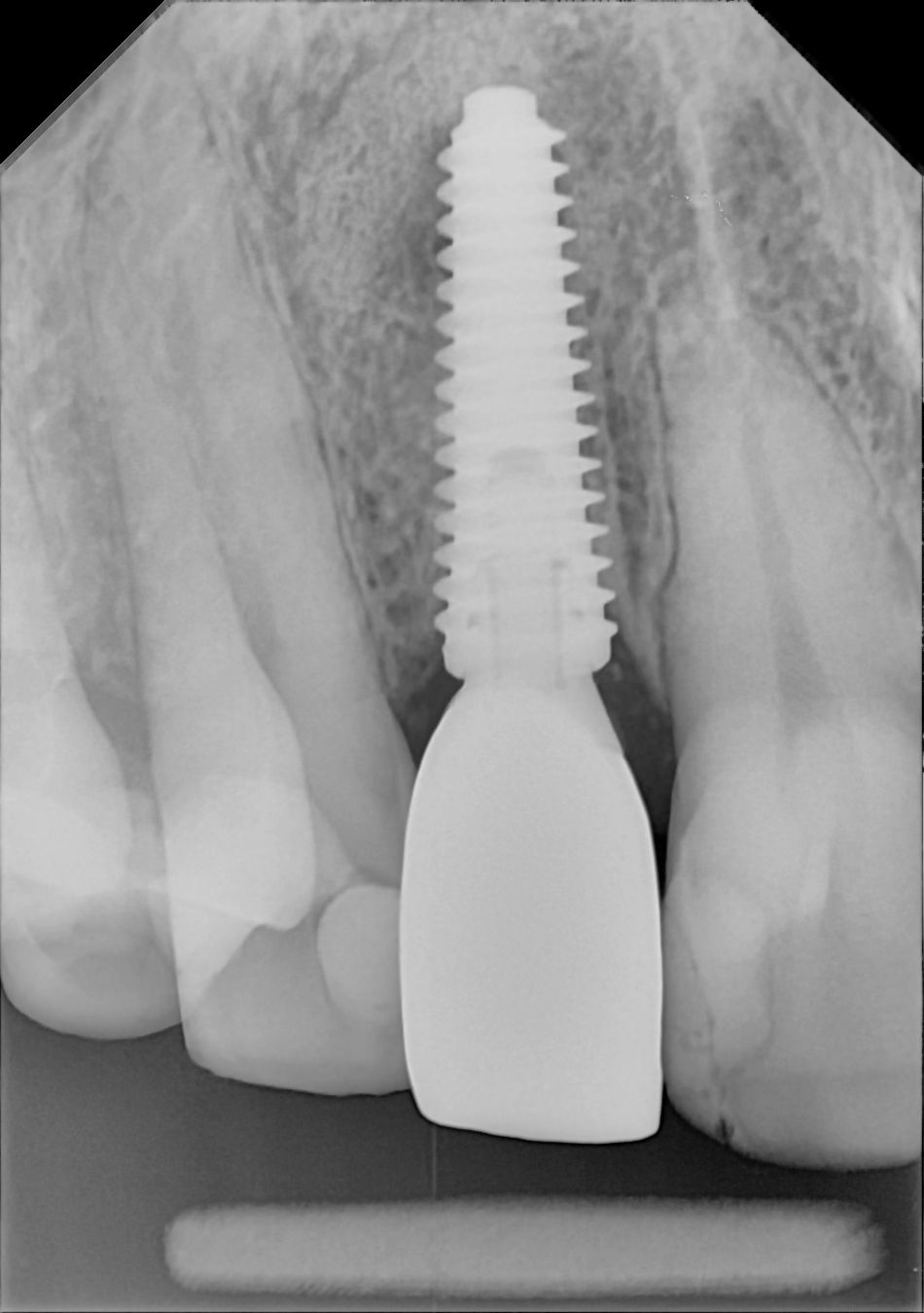 An example anterior periapical radiograph acquired with the DC-Air® wireless dental x-ray sensor.