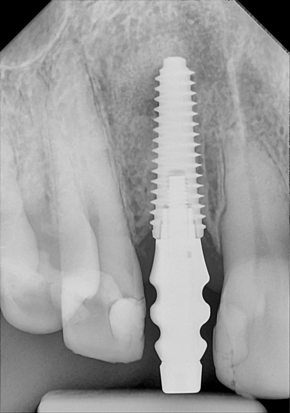 An example anterior periapical radiograph acquired with the DC-Air® wireless dental x-ray sensor.
