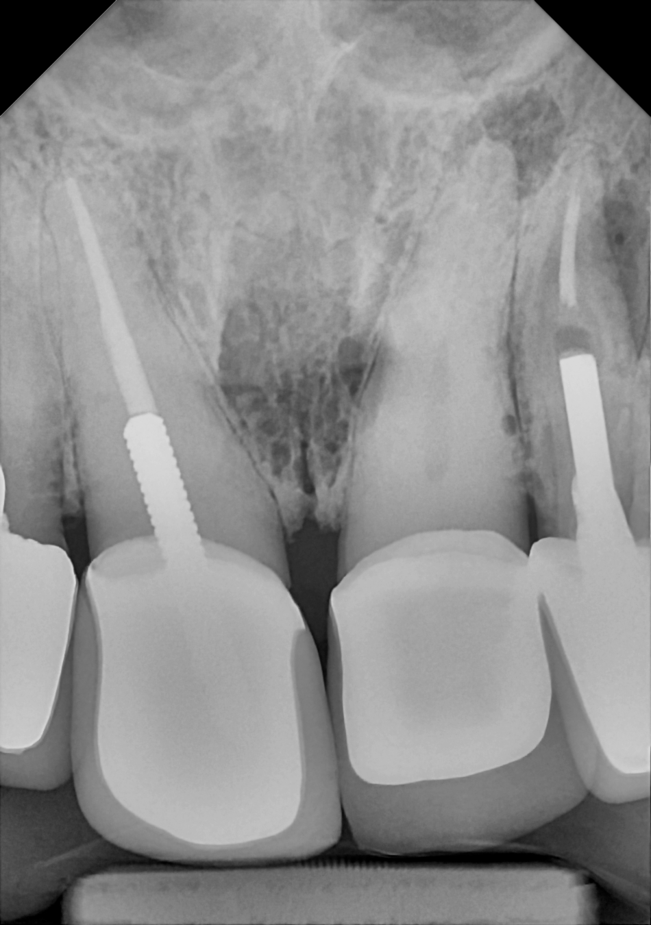 An example anterior periapical radiograph acquired with the DC-Air® wireless dental x-ray sensor.