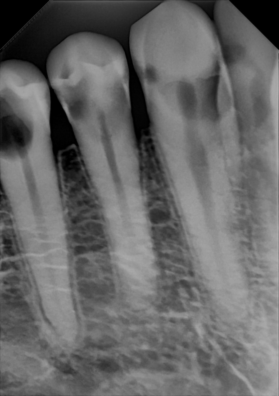 An example anterior periapical radiograph acquired with the DC-Air® wireless dental x-ray sensor.