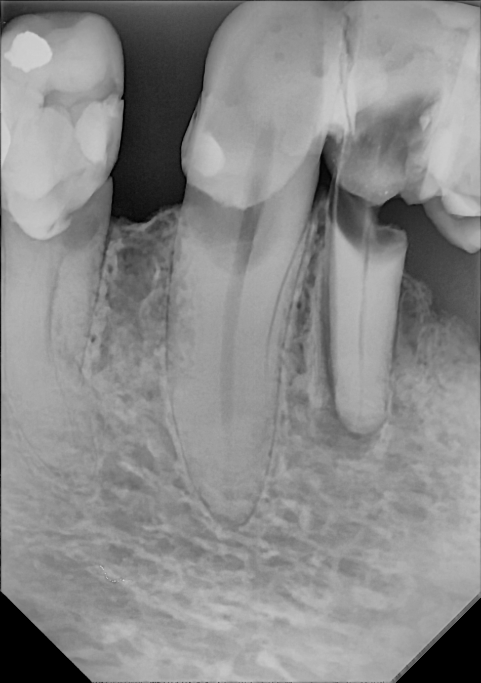 An example anterior periapical radiograph acquired with the DC-Air® wireless dental x-ray sensor.