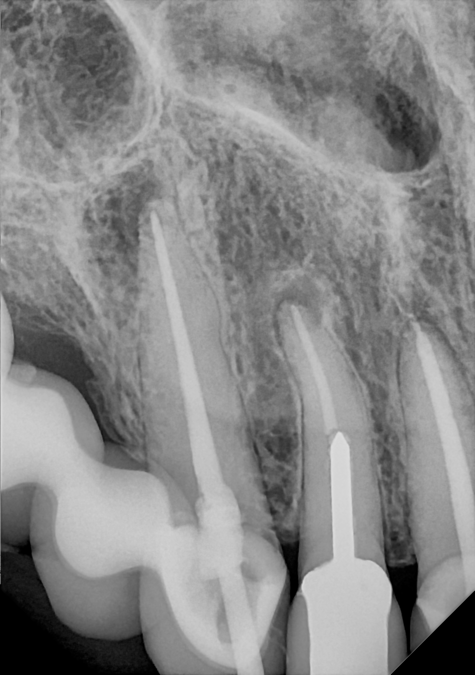 An example anterior periapical radiograph acquired with the DC-Air® wireless dental x-ray sensor.