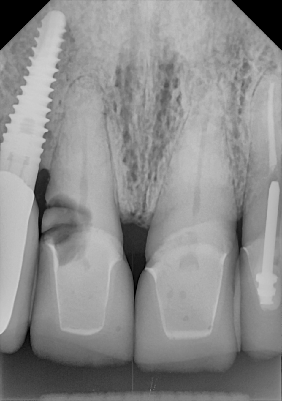 An example anterior periapical radiograph acquired with the DC-Air® wireless dental x-ray sensor.