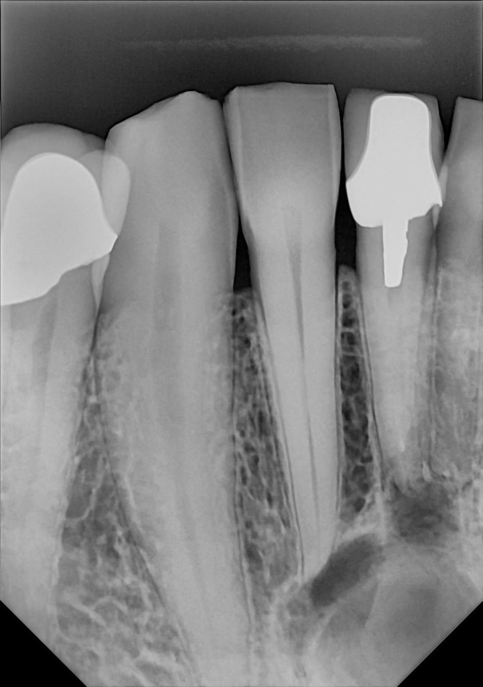 An example anterior periapical radiograph acquired with the DC-Air® wireless dental x-ray sensor.
