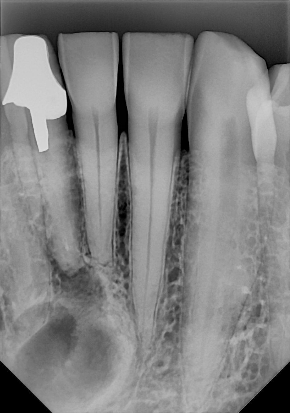 An example anterior periapical radiograph acquired with the DC-Air® wireless dental x-ray sensor.