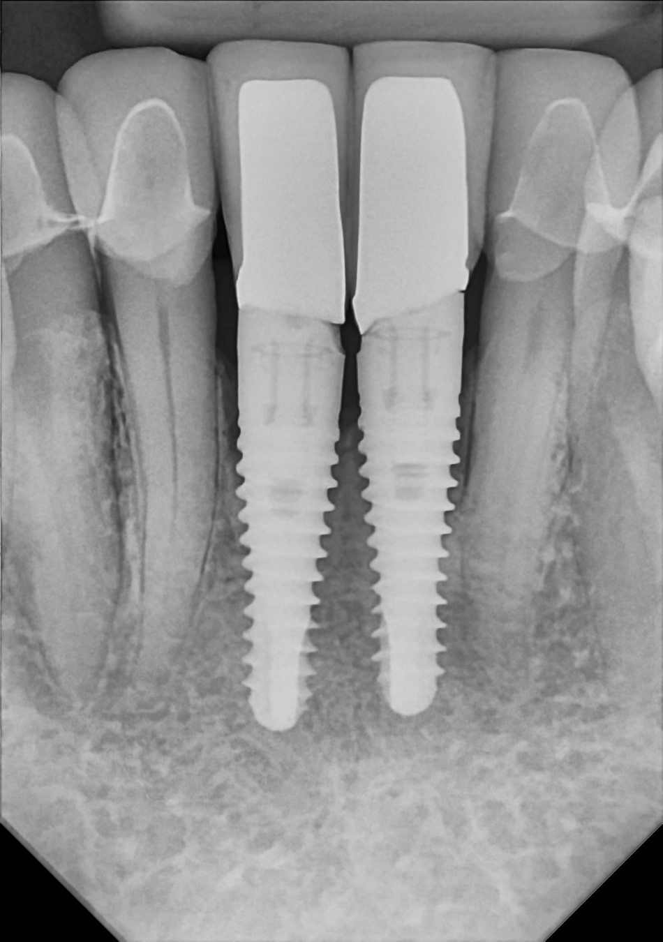 An example anterior periapical radiograph acquired with the DC-Air® wireless dental x-ray sensor.