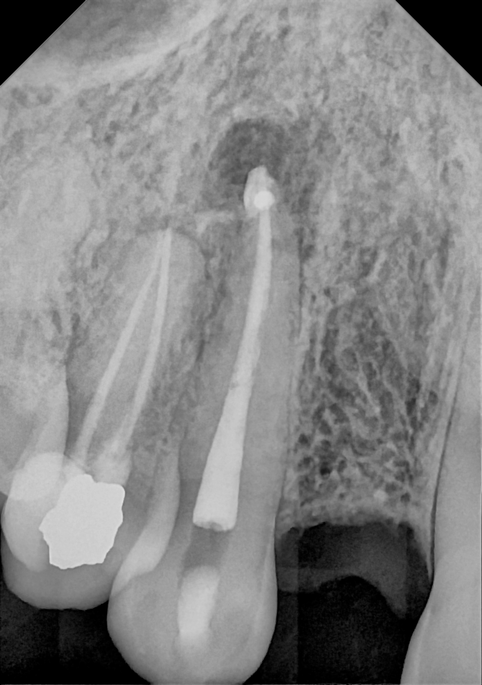 An example anterior periapical radiograph acquired with the DC-Air® wireless dental x-ray sensor.