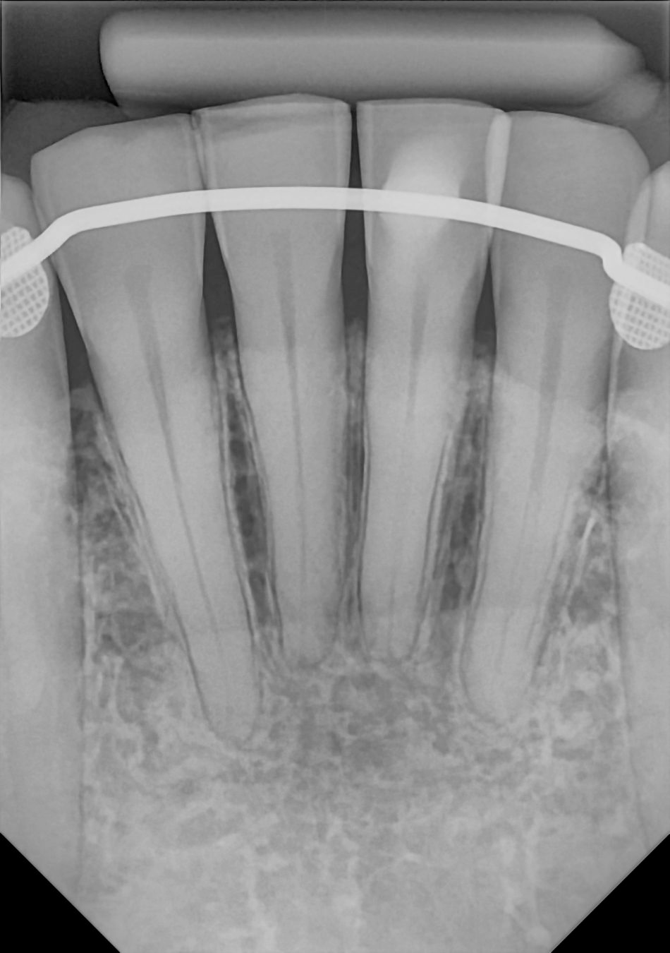 An example anterior periapical radiograph acquired with the DC-Air® wireless dental x-ray sensor.