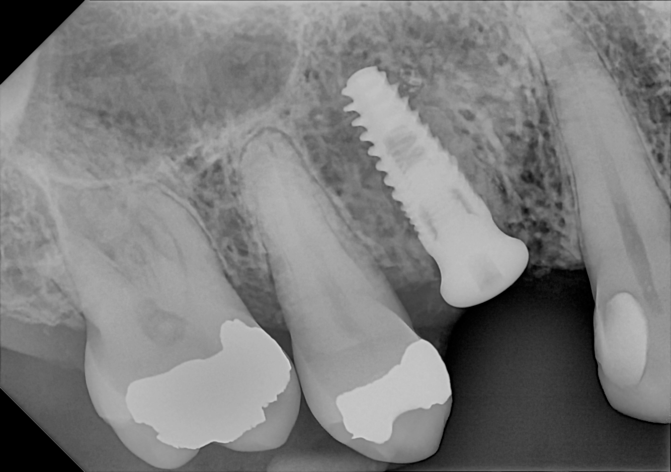 An example posterior periapical radiograph acquired with the DC-Air® wireless dental x-ray sensor.