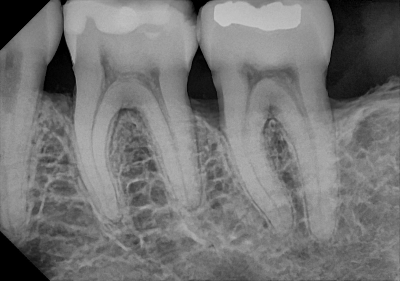 An example posterior periapical radiograph acquired with the DC-Air® wireless dental x-ray sensor.