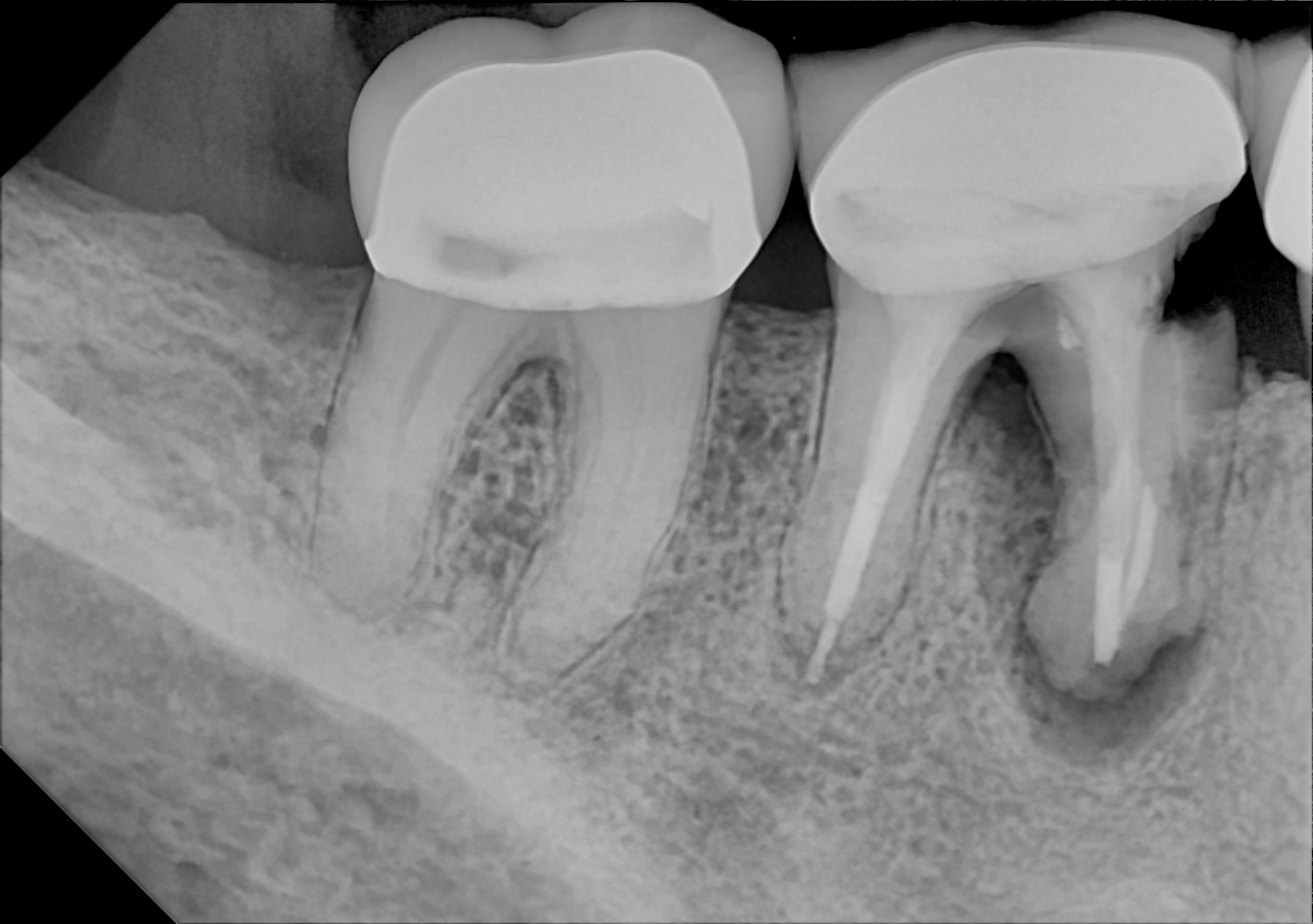 An example posterior periapical radiograph acquired with the DC-Air® wireless dental x-ray sensor.
