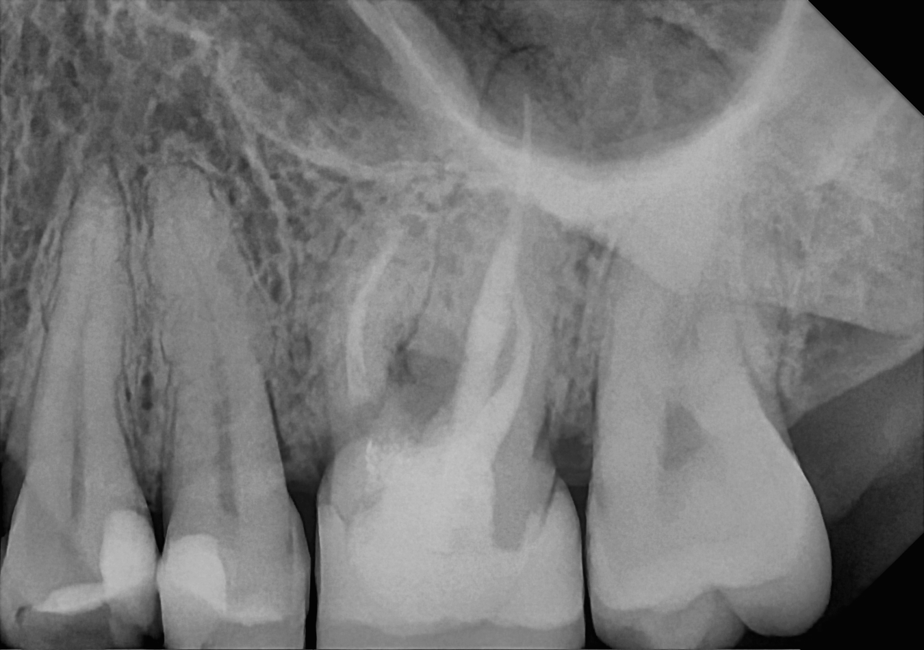 An example posterior periapical radiograph acquired with the DC-Air® wireless dental x-ray sensor.