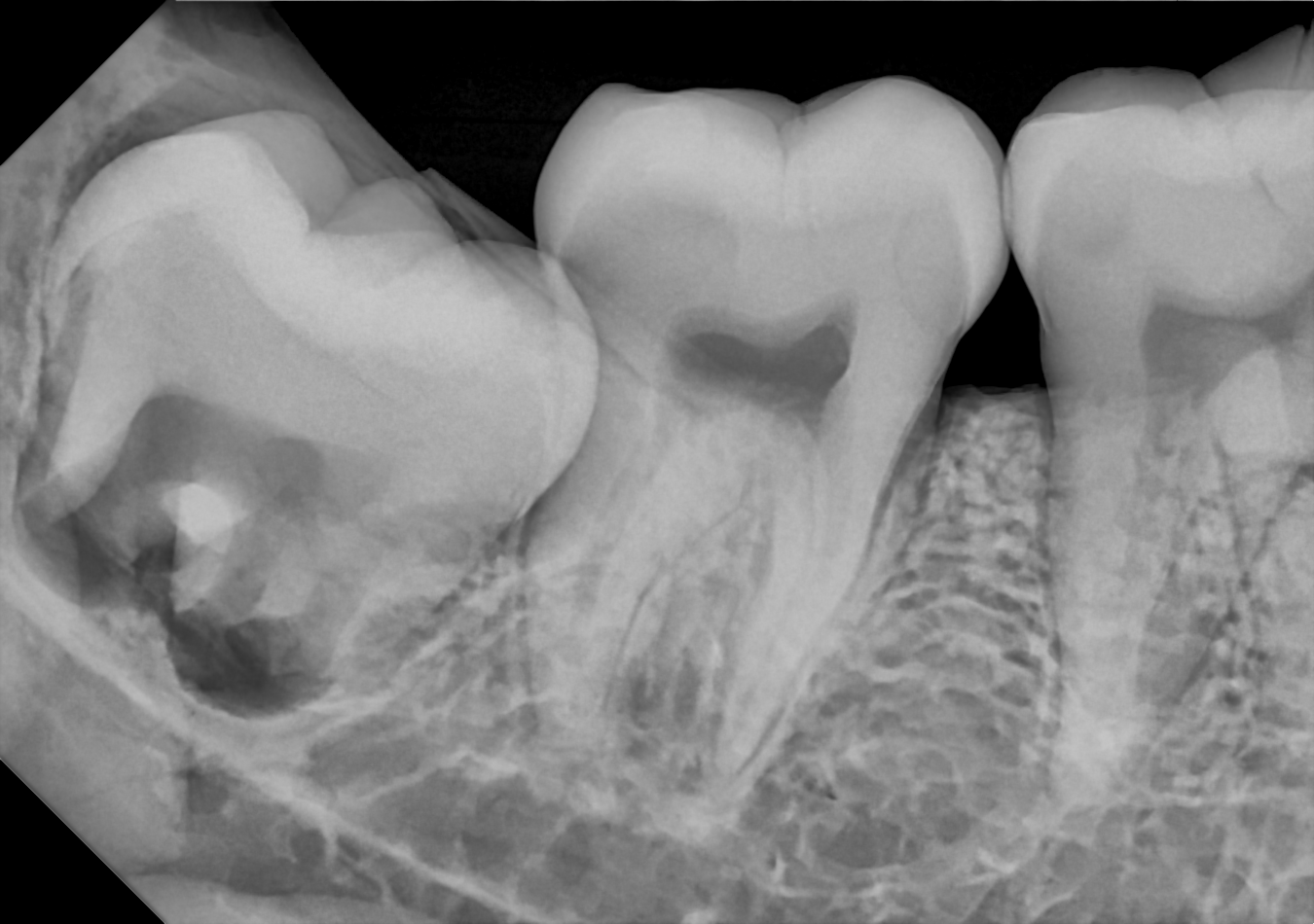 An example posterior periapical radiograph acquired with the DC-Air® wireless dental x-ray sensor.