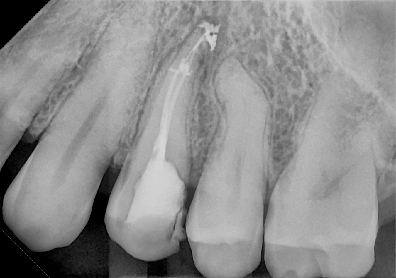 An example posterior periapical radiograph acquired with the DC-Air® wireless dental x-ray sensor.