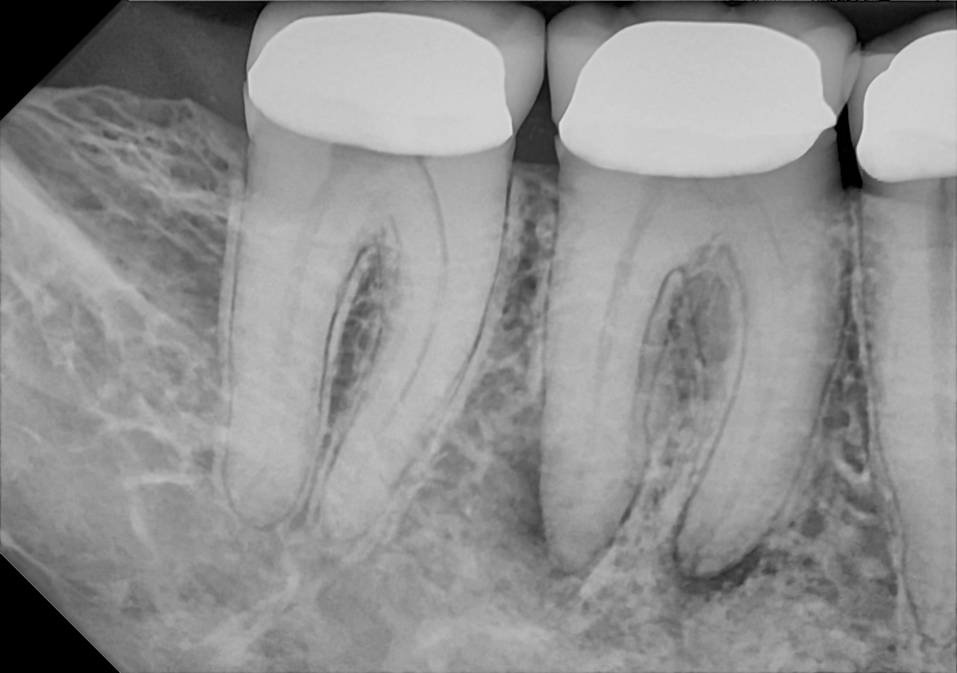 An example posterior periapical radiograph acquired with the DC-Air® wireless dental x-ray sensor.