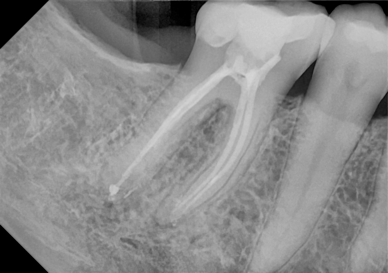 An example posterior periapical radiograph acquired with the DC-Air® wireless dental x-ray sensor.