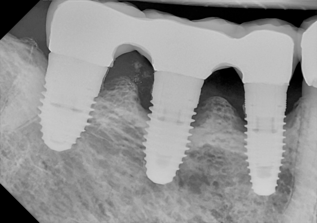 An example posterior periapical radiograph acquired with the DC-Air® wireless dental x-ray sensor.