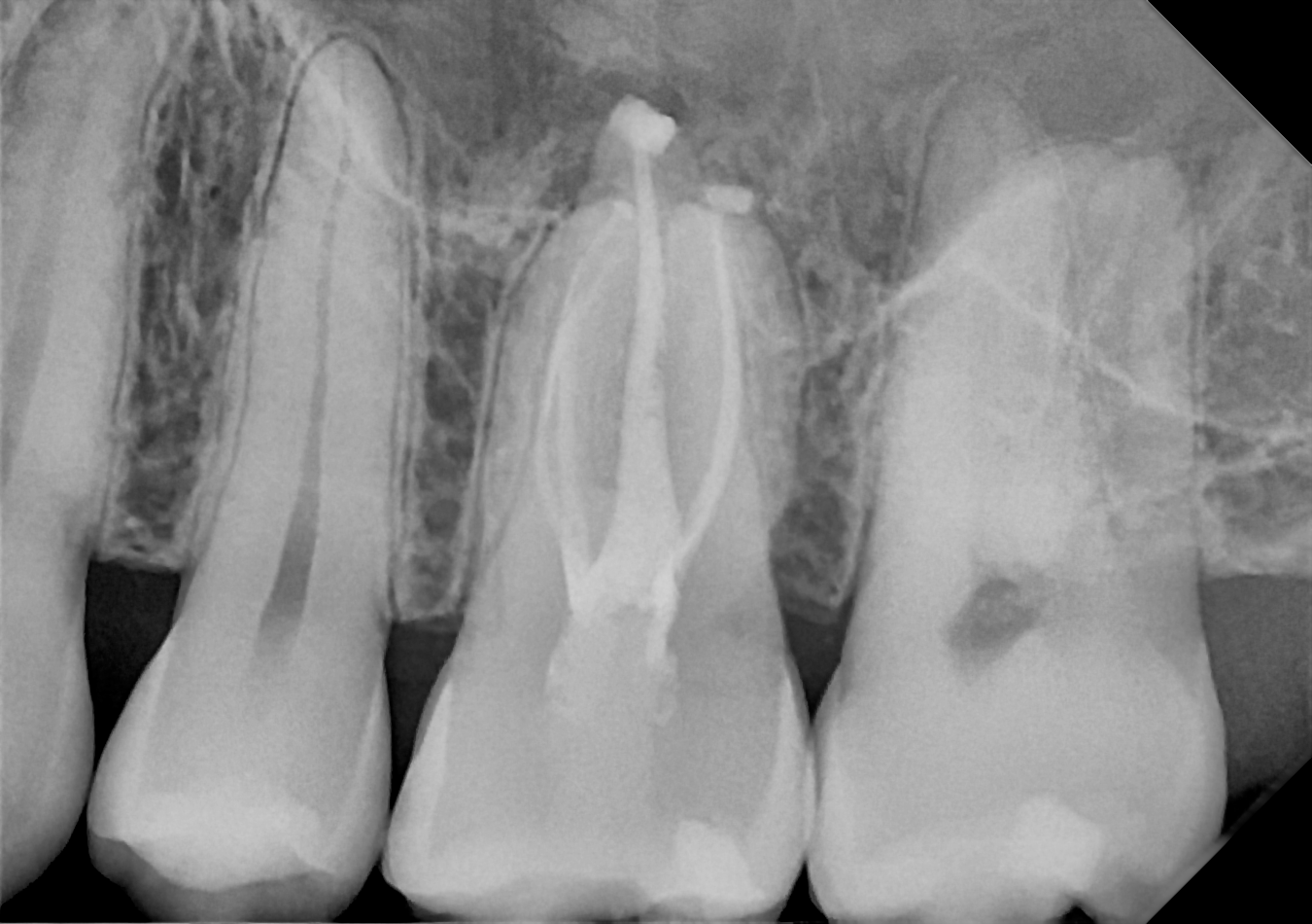 An example posterior periapical radiograph acquired with the DC-Air® wireless dental x-ray sensor.