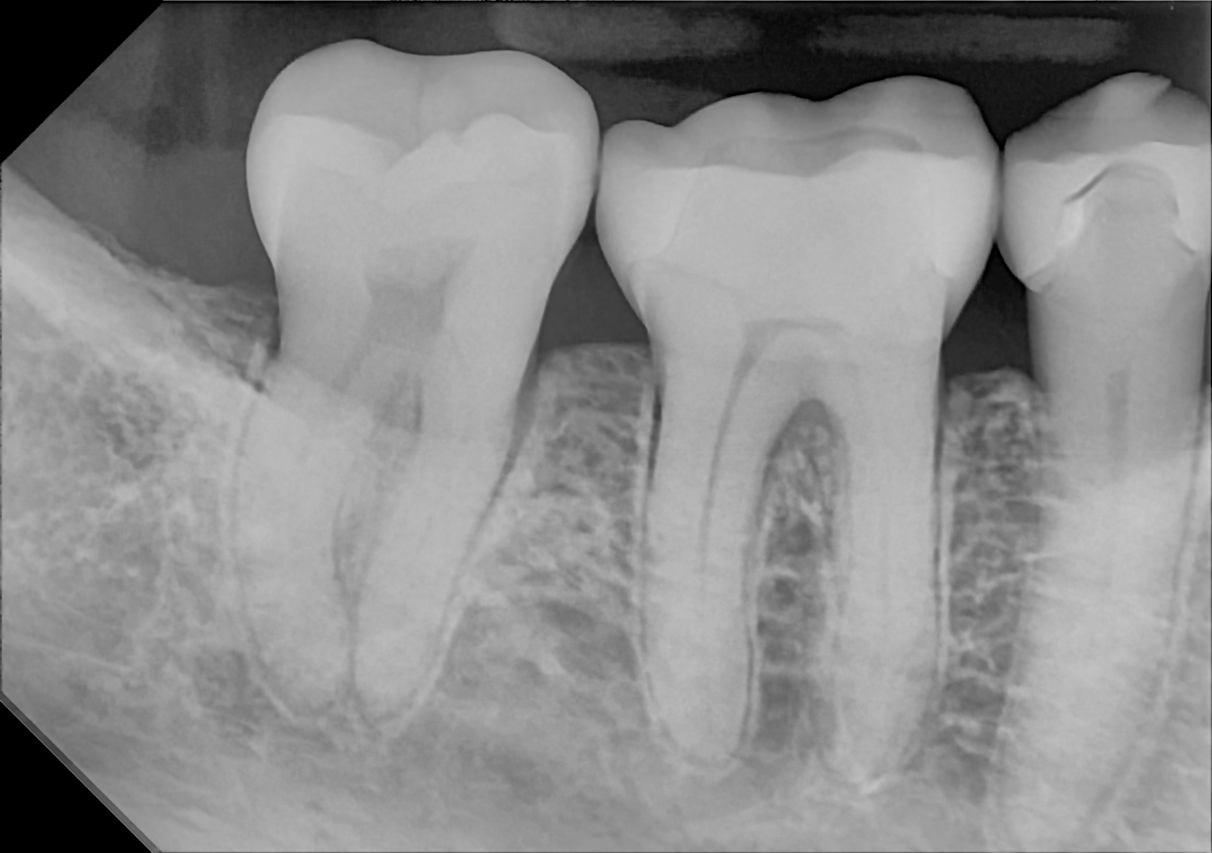 An example posterior periapical radiograph acquired with the DC-Air® wireless dental x-ray sensor.
