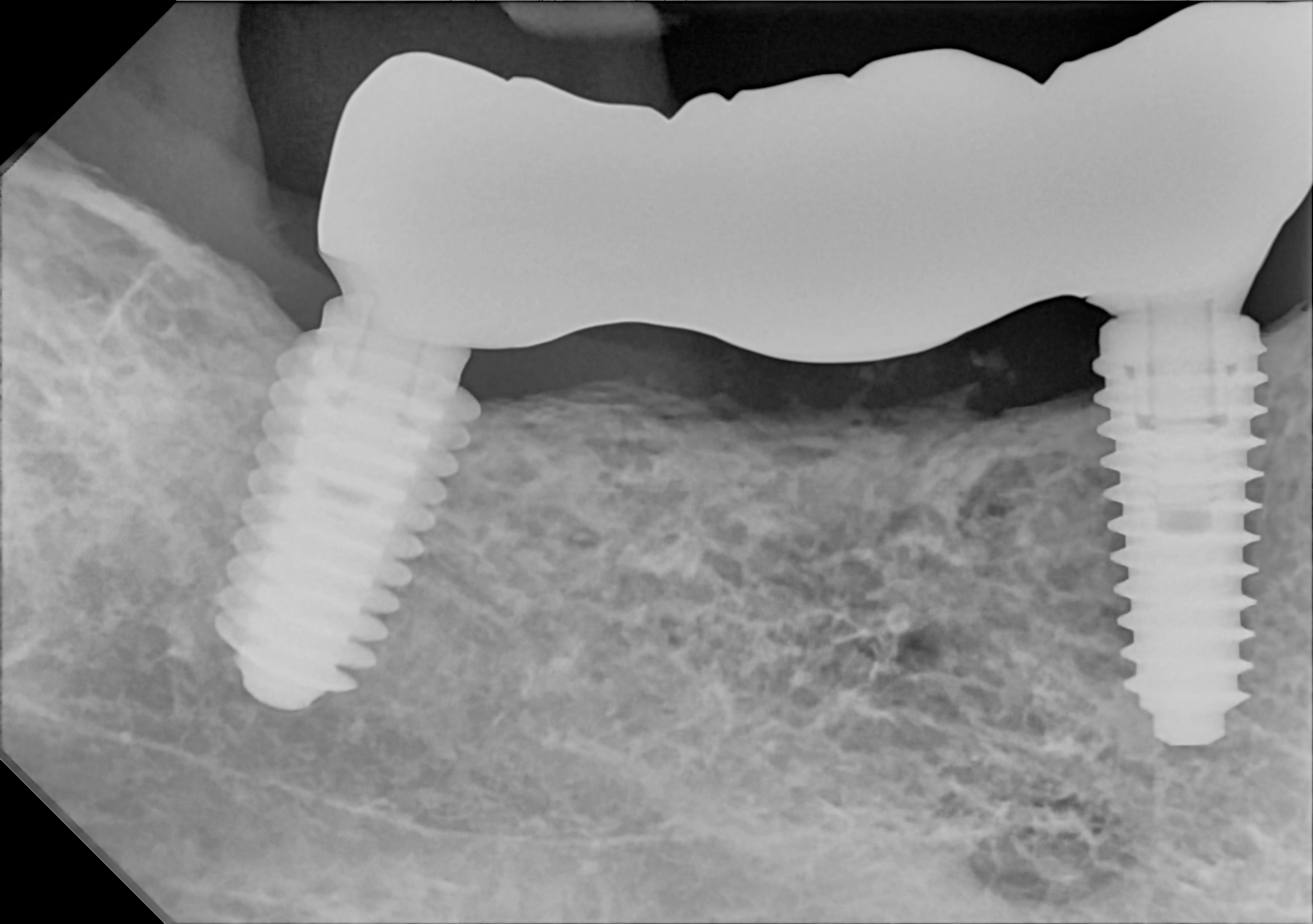 An example posterior periapical radiograph acquired with the DC-Air® wireless dental x-ray sensor.