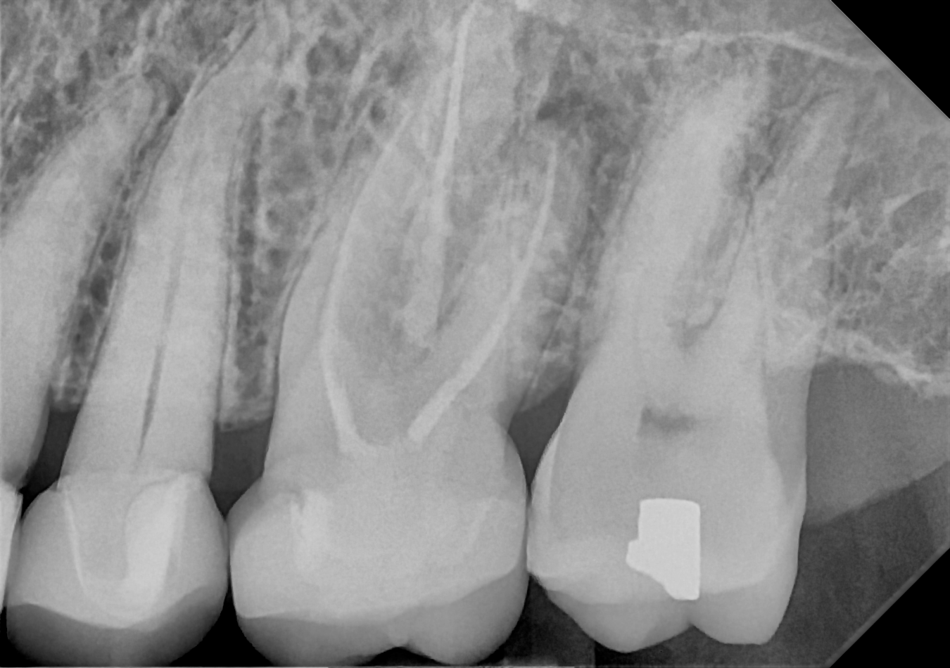 An example posterior periapical radiograph acquired with the DC-Air® wireless dental x-ray sensor.