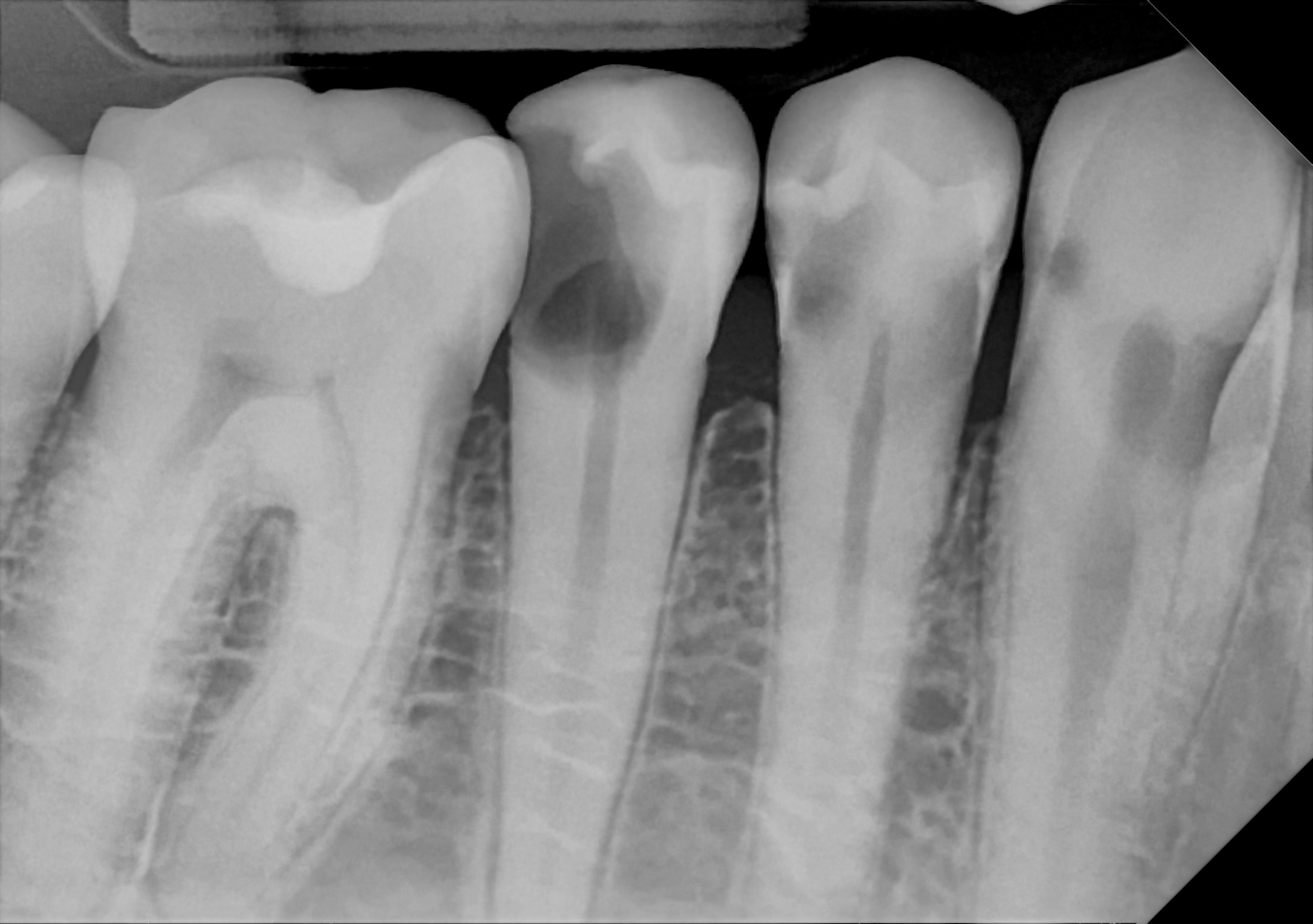 An example posterior periapical radiograph acquired with the DC-Air® wireless dental x-ray sensor.