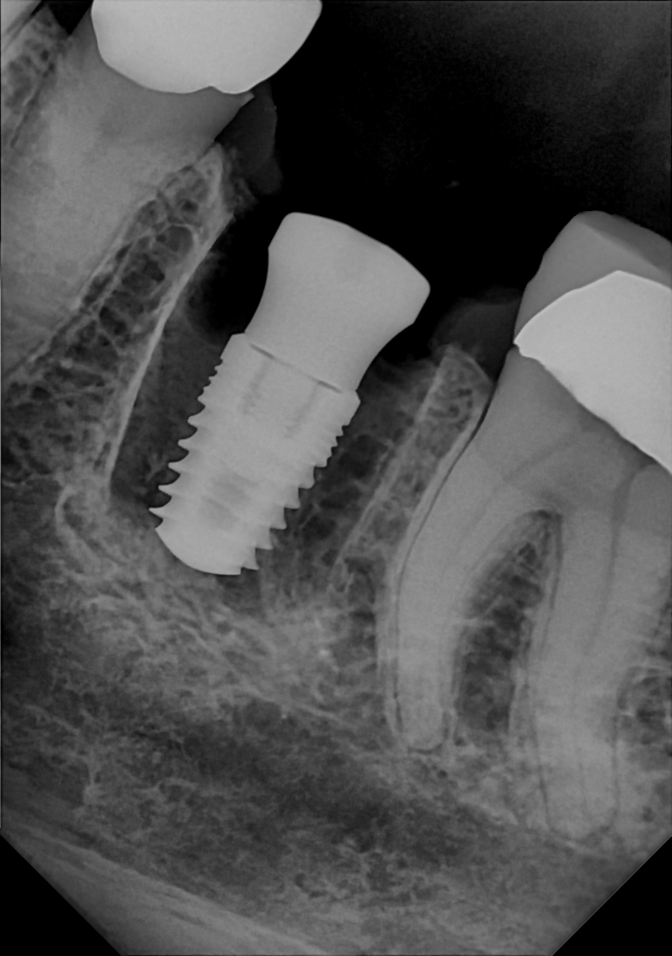 An example radiograph acquired with the Zero Profile® Endodontic holder for the DC-Air® wireless dental x-ray sensor.