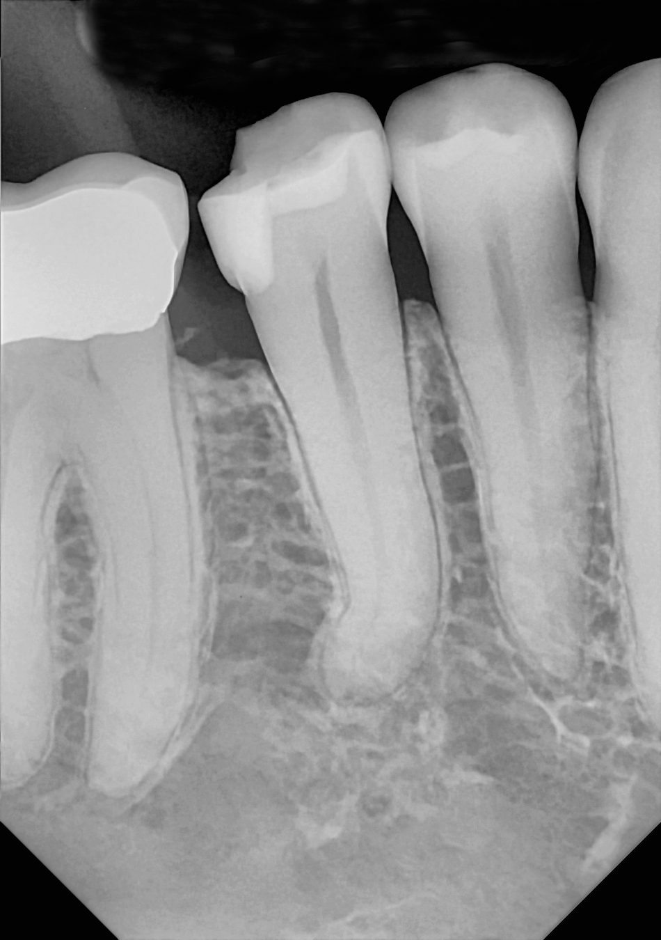 An example radiograph acquired with the Zero Profile® Endodontic holder for the DC-Air® wireless dental x-ray sensor.
