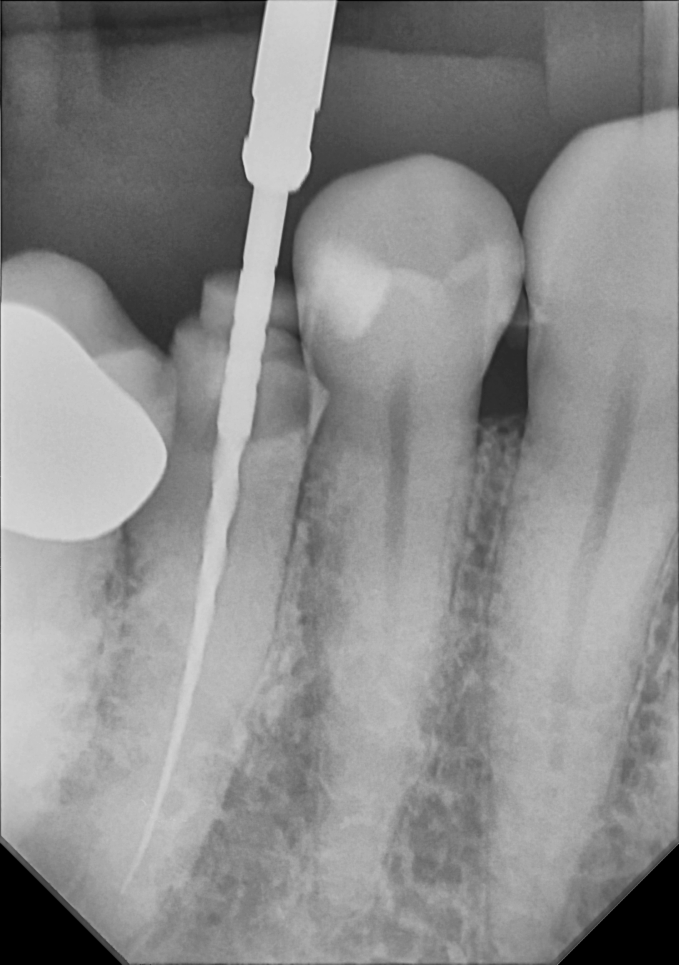 An example radiograph acquired with the Zero Profile® Endodontic holder for the DC-Air® wireless dental x-ray sensor.