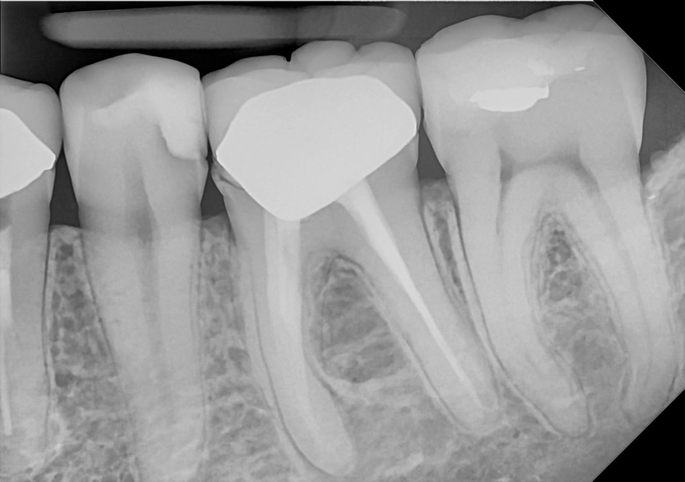 An example posterior periapical radiograph acquired with the DC-Air® wireless dental x-ray sensor.