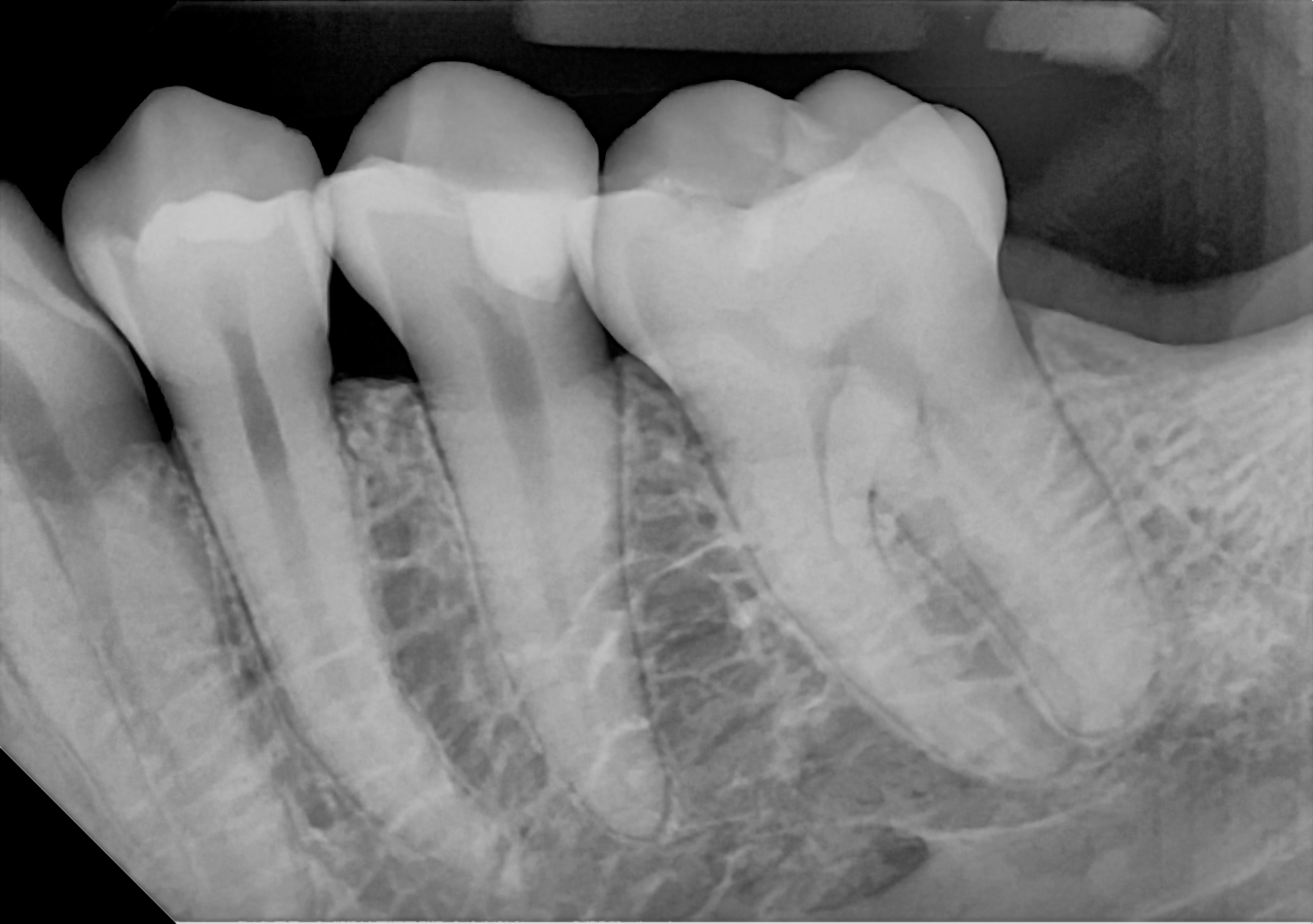 An example posterior periapical radiograph acquired with the DC-Air® wireless dental x-ray sensor.