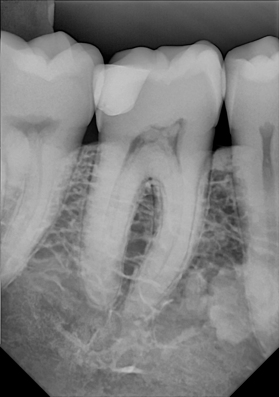 An example radiograph acquired with the Zero Profile® Endodontic holder for the DC-Air® wireless dental x-ray sensor.
